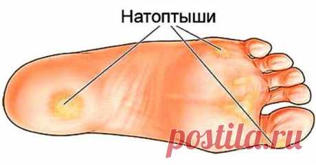 ПРОСТЫЕ РЕЦЕПТЫ ДЛЯ УСТРАНЕНИЯ НАТОПТЫШЕЙ, ТРЕЩИН, МОЗОЛЕЙ, СОСУДИСТОЙ СЕТКИ И ВАРИКОЗА! — Копилочка полезных советов