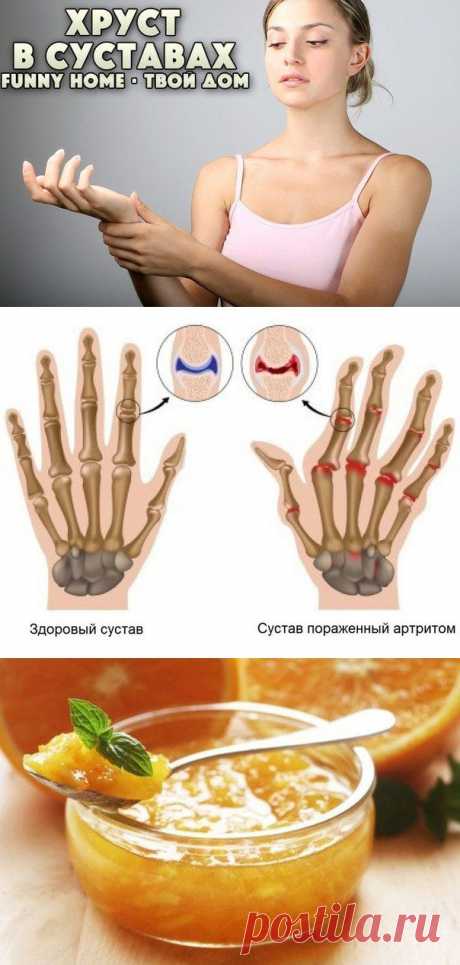 ЛЕЧЕНИЕ СУСТАВОВ | Записи в рубрике ЛЕЧЕНИЕ СУСТАВОВ | Дневник NADIABI