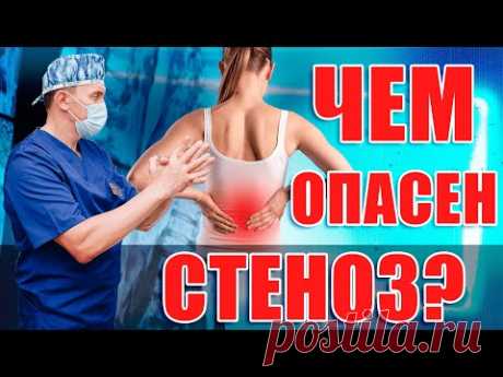 Стеноз, какие последствия не лечения? Ответы на вопросы