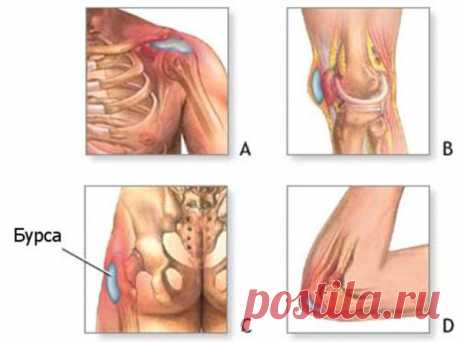 Бурсит: виды, причины, проявления, лечение | KinesioPro