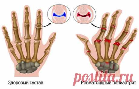 Полиартрит суставов: симптомы и лечение заболевания народными средствами