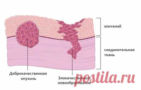 Доброкачественные и злокачественные опухоли: отличия, признаки, виды и характеристики, диагностика новообразований