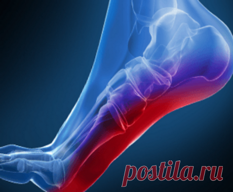 Упражнения от боли в стопе и пятке Причиной боли в ногах может быть заболевание под названием подошвенный фасциит. Это воспаление ткани, проходящей по нижней стороны стопы и соединяющей пальцы ног и пятку.