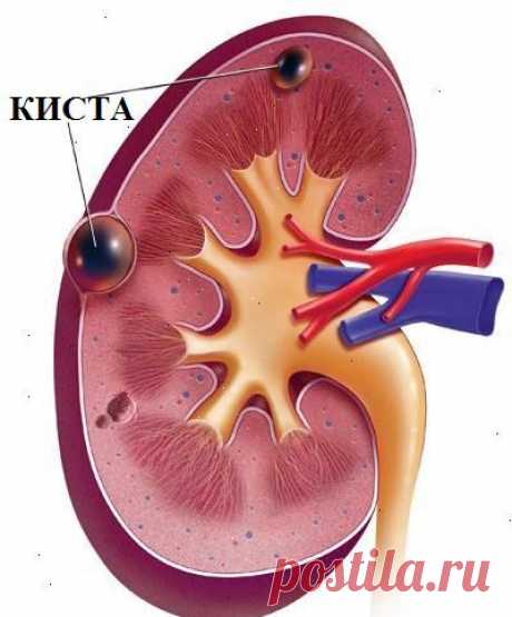 Что делать чтобы рассосалась киста на почке: эффективное лечение