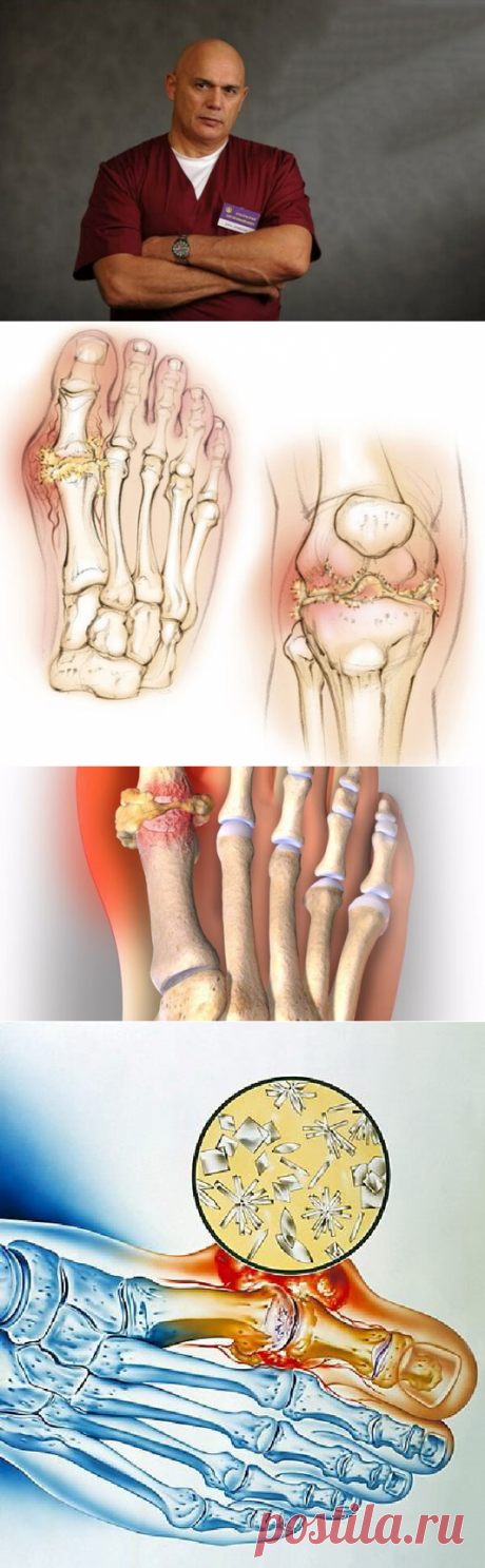 Лечение подагры в домашних условиях по доктору Бубновскому | Секреты Долголетия | Яндекс Дзен