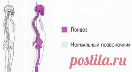 Лордоз позвоночника — что это такое, лечение физиологического лордоза Лордоз – это физиологический или патологический изгиб позвоночника с выпуклостью вперед. В норме он есть у всех людей в шейном и поясничном отделе. В отличие от физиологического, для патологического лордоза характерный выраженный изгиб. Это приводит к изменению осанки и боли в спине. Лечение может