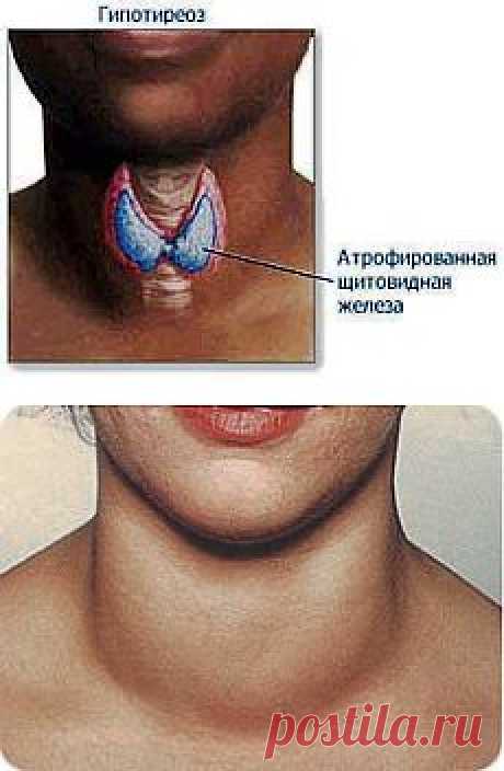 Щитовидная железа. Болезни и лечение щитовидки.