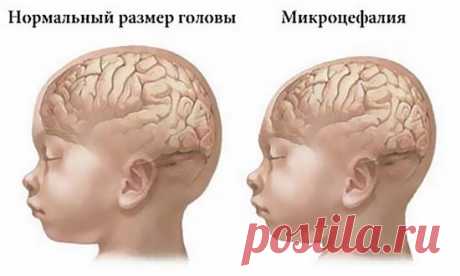 Маленькая голова: что за болезнь, причины и лечение