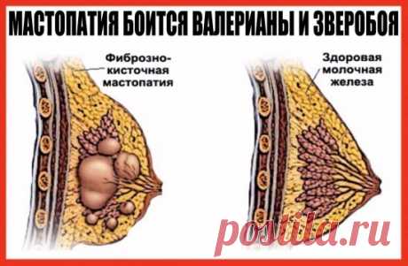 МАСТОПАТИЯ БОИТСЯ ВАЛЕРИАНЫ И ЗВЕРОБОЯ
Услышав от врачей диагноз «мастопатия», многие женщины впадают в отчаяние. Советуют лишь проверять молочные железы каждый год, а вот если уплотнение начнет расти, тогда … придется, видимо, оперировать. Утешение, сами понимаете, слабое. А вот народная медицина знает немало естественных средств, с помощью которых можно облегчить с