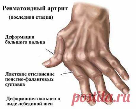 Система Соколинского при ревматоидном артрите.
