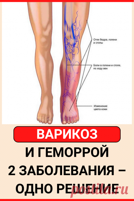 Варикоз и геморрой. 2 заболевания – одно решение
#здоровье #варикоз #геморрой #советы #полезные_советы #жизненные_советы