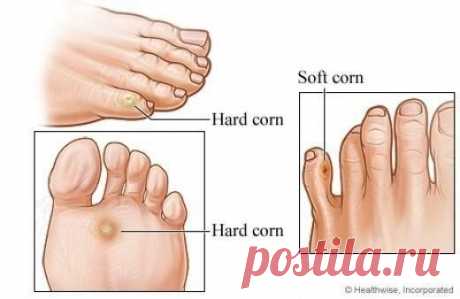 Избавляемся от мазолей народными средствами | Женский журнал