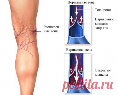 Волшебная мазь. От варикозного расширения вен. | У МЕНЯ В ГОСТЯХ. | Яндекс Дзен