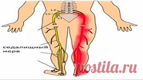 Воспаление седалищного нерва. Лечение в домашних условиях.
