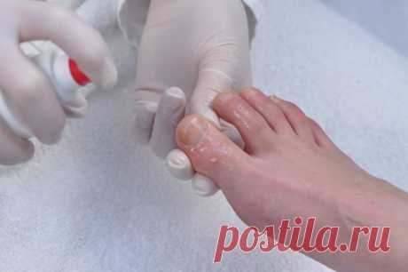 Грибок ногтей у пожилых людей - О грибке ногтей

Пероксид водорода прекрасно удаляет грибок ногтей на ногах в запущенной (хронической) форме, но лечение будет достаточно длительным. ... Итак, как вылечить запущенный грибок ногтей на ногах при помощи пероксида водорода?