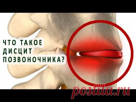 Что нужно знать о дисците позвоночника