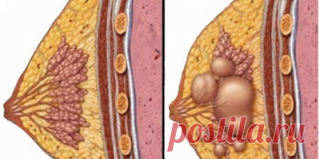 Вы не должны ложиться под нож: Лечение любых видов кист теперь возможно с этим рецептом! » MAKATAKA