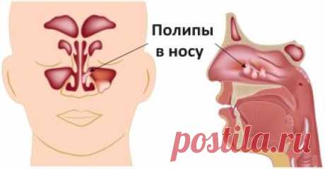 Лечение полипов носа народными средствами - 22 рецепта! Лечение полипов носа народными средствами. Стадии, симптомы полипоза. Рецепты народной медицины - промывание, тампоны, мази, сокотерапия. Видеорекомендации.