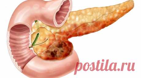 Ранние и неожиданные признаки панкреатита и рака поджелудочной железы — В Курсе Жизни