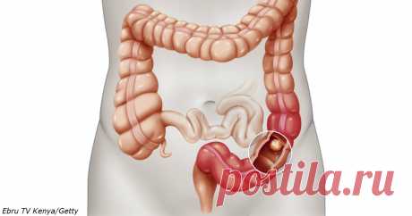 5 признаков колоректального рака, о которых должна знать каждая женщина 
Чем раньше, тем лучше.

Рак толстого кишечника - очень опасное заболевание, которому подвержены жители стран с развитой экономикой. Они становятся жертвами своих нездоровых пищевых пристрастий.
Вы то…