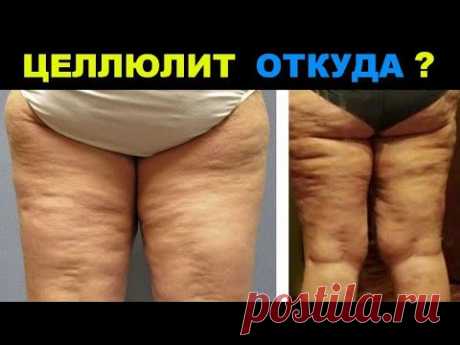 ЦЕЛЛЮЛИТ ОТКУДА ? / ЦЕЛЛЮЛИТ на БЕДРАХ и ЯГОДИЦАХ