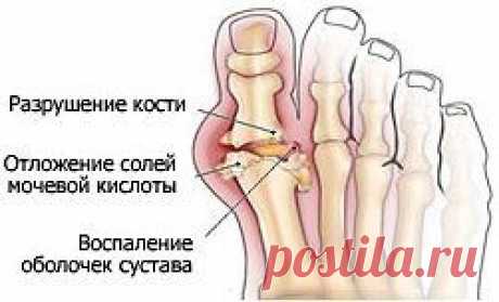 Как вылечить косточку на ноге.