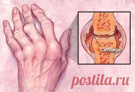 Восемь мифов и фактов о ревматоидном артрите