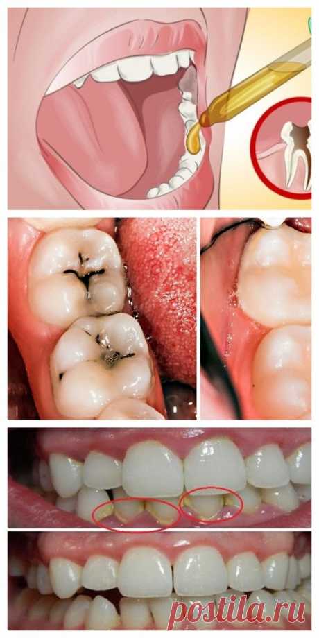 8 простых способов избавиться от кариеса и дыр в зубах естественным путем