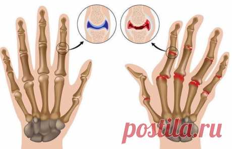 Средства, которые помогут успокоить симптомы артрита Артрит является заболеванием, характеризующимся сильными болями. Почему оно развивается? Заболевание появляется, когда хрящи наших суставов изнашиваются и кости начинают тереться друг об друга.У челов...