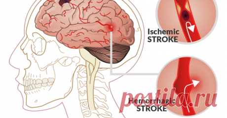 Первые признаки, указывающие на инсульт! / Будьте здоровы