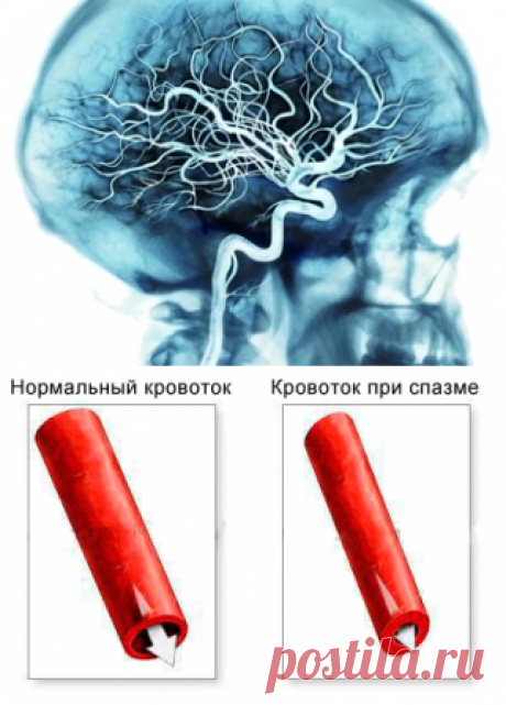 Как можно снять спазм сосудов головного мозга, а также симптомы и лечение