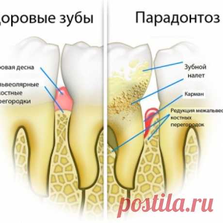 Чем лечить пародонтоз в домашних условиях