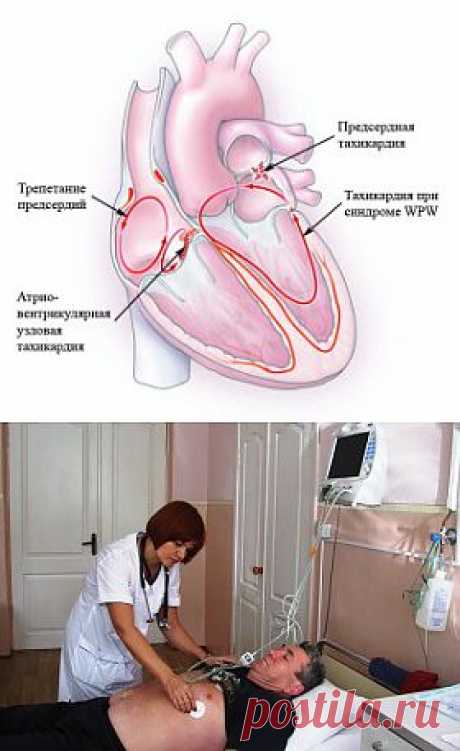 Тахикардия: причины, симптомы и лечение