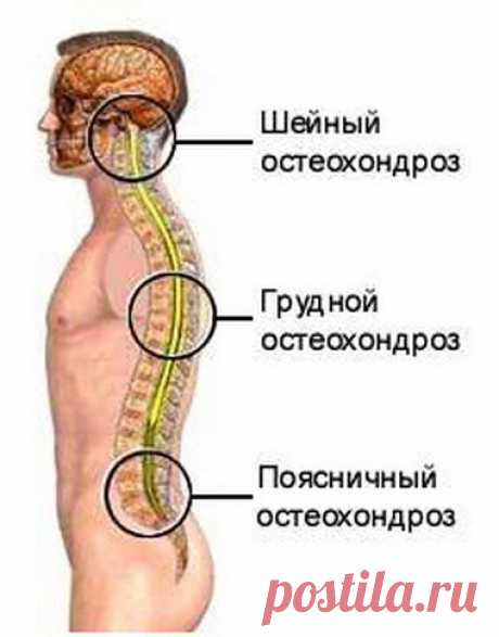 ОСТЕОХОНДРОЗ.