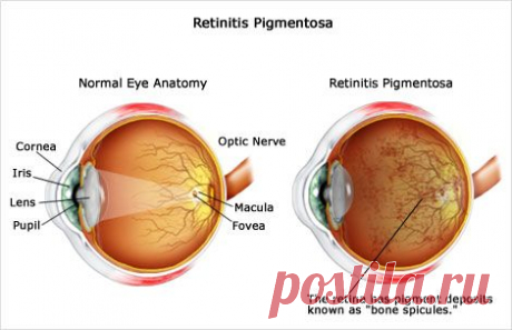 Ретинит. Симптомы и лечение ретинита