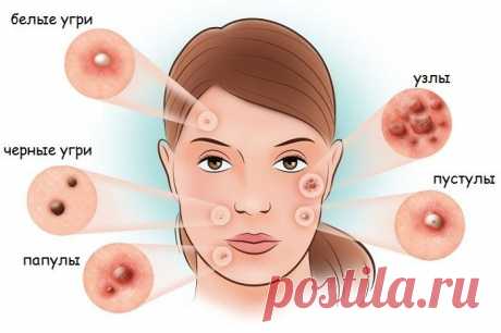 Эффективные и дешевые мази от прыщей . Милая Я