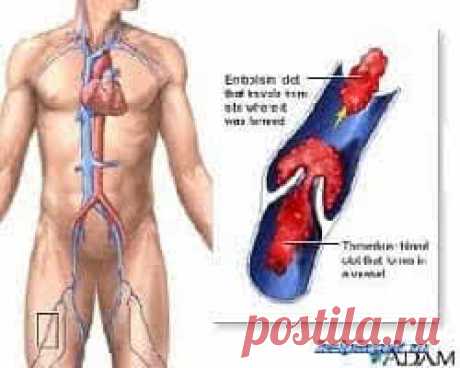 Средства для разжижения крови |