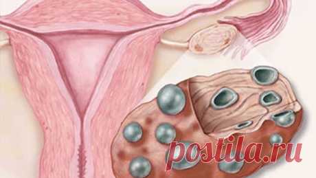 Поликистоз (кисты яичников)