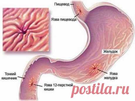 Язва желудка: симптомы, лечение, лекарства, диета, осложнения | Азбука здоровья