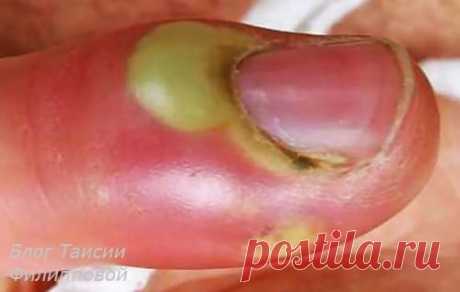 Панариций пальца – лечение в домашних условиях