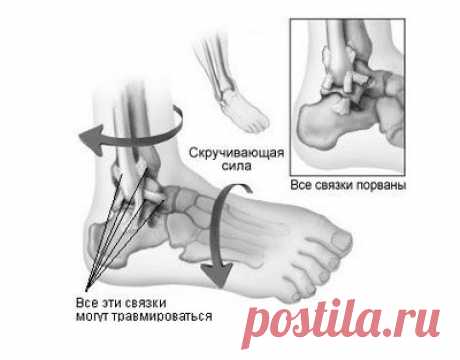 Растяжение. Вывих. Народные методы лечения вывихов и растяжений