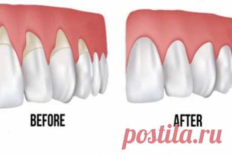 10 ЛЕГКИХ ПРИРОДНЫХ СПОСОБОВ ЛЕЧЕНИЯ ОТСТУПАЮЩИХ ДЕСЕН – БУДЬ В ТЕМЕ