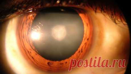 Найден способ вылечить катаракту с помощью глазных капель