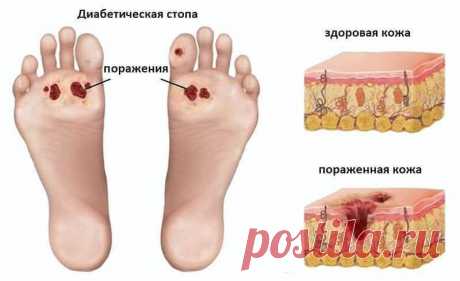 Диабетическая стопа: что это и как лечить? | Всегда в форме!