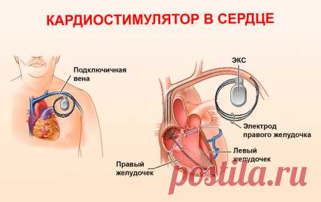 Кардиостимулятор сердца: противопоказания по возрасту, стоимость операции, показания к установке, отзывы пациентов, видео