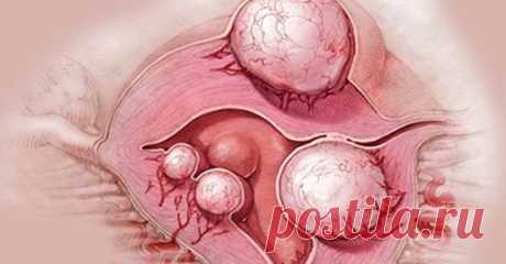 Лекарство от кисты и миомы 
Большинство пациентов — молодые женщины и женщины в предменопаузе.
Этому заболеванию подвержены тысячи женщин во всем мире! Натуральные рецепты помогают успешно избавиться от него!
Эти кисты и миомы …