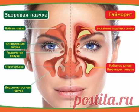 Домашнее лечение гайморита и синусита — Делимся советами