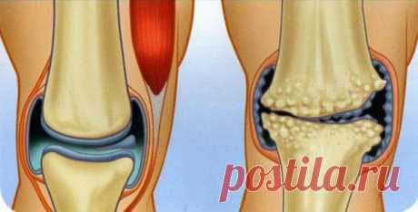 Природное средство для регенерации хрящей коленного сустава и бедра! Отличный результат всего за 3 недели! | Женский журнал - все своими руками