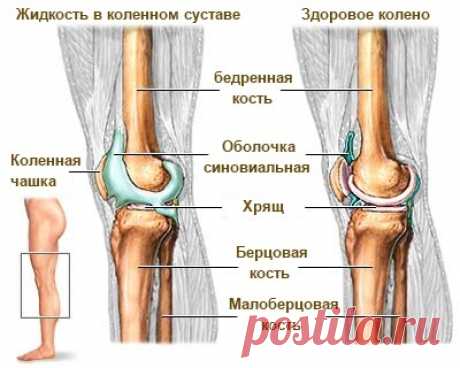 Жидкость в коленном суставе? Смотрите простейший способ избавиться от нее!