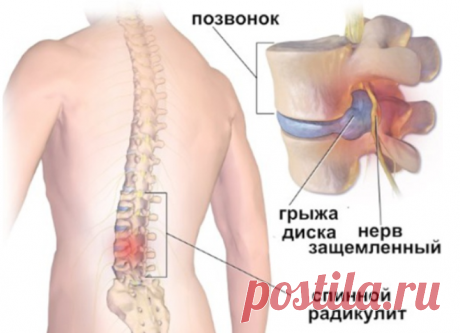 Этот рецепт хорошо помогает и при обычном радикулите, миозите, ушибах и межреберной невралгии - Упражнения и похудение Прочь радикулит! Готовим раствор: * Соединить в равных пропорциях йод с глицерином (продается в аптеке), хорошо встряхнуть бутылочку (она должна быть из темного стекла) и ватным тампоном, смоченным в этой смеси, смазать спину и всю больную область, кроме позвоночника. Втирать не надо, просто смазать. * Затем надеть х/б белье (тепло не укрываться!) и лечь спать. …